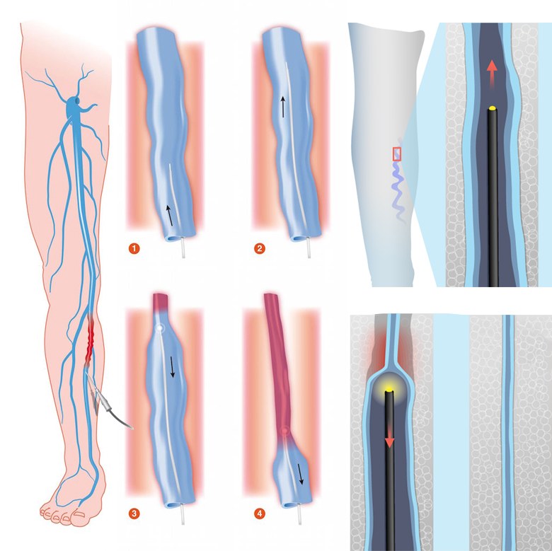 atlantis_lazer_profesyonel_medikal_varis